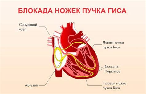 Что такое блокада правого желудочка сердца?