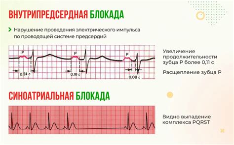 Что такое блокада сердца при ЭКГ у ребенка?