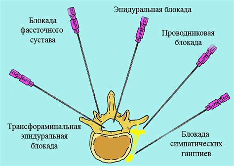 Что такое блокада спины?