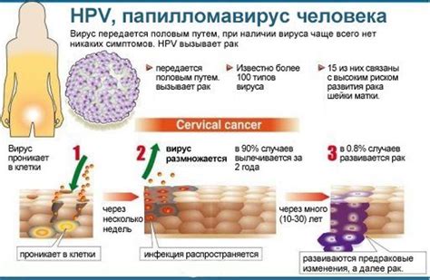 Что такое вирус папилломы человека и как он передается женщинам