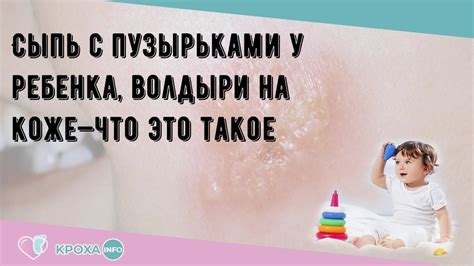 Что такое волдыри на коже?