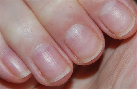 Что такое волнообразные ногти?