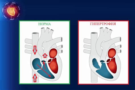 Что такое гипертрофия правого предсердия и как она возникает?