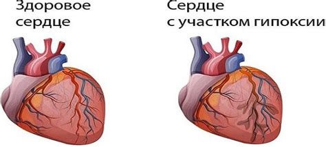 Что такое гипоксия?