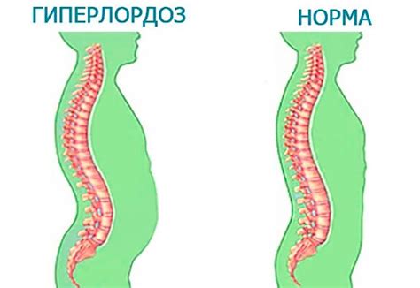 Что такое гиполордоз поясничный?