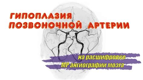 Что такое гипоплазия правого поперечного синуса?