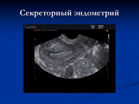 Что такое гипоэстрогенный постклимактерический эндометрий (ГПЭ)