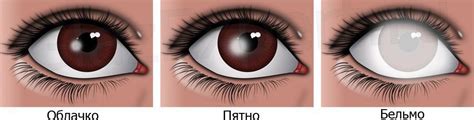 Что такое глазовое белое пятно?