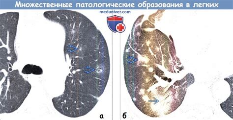 Что такое гомогенное образование в легком?