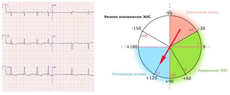 Что такое горизонтальная ось сердца на ЭКГ?