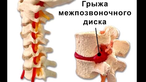 Что такое грыжа бокового пространства впереди?