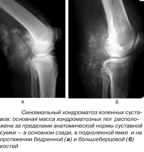 Что такое дефицит смазки в коленном суставе?