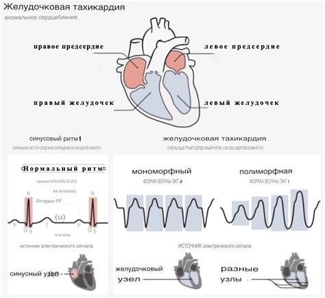 Что такое желудочковая тахикардия?