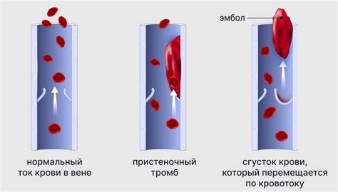 Что такое жесткие сосуды и для чего они нужны?