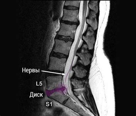 Что такое задняя грыжа