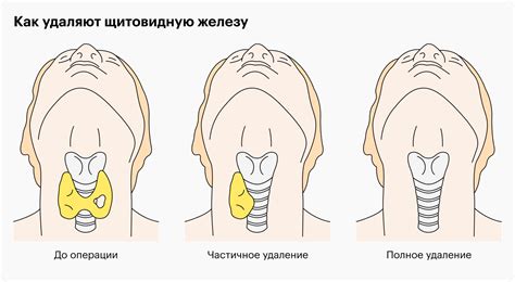 Что такое инкапсулированный папиллярный рак щитовидной железы?