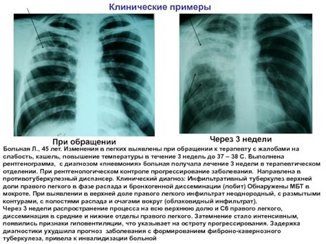 Что такое инфильтративные изменения правого легкого?