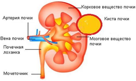 Что такое киста почек?