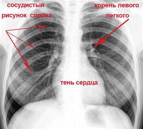 Что такое код 25 при флюорографии?