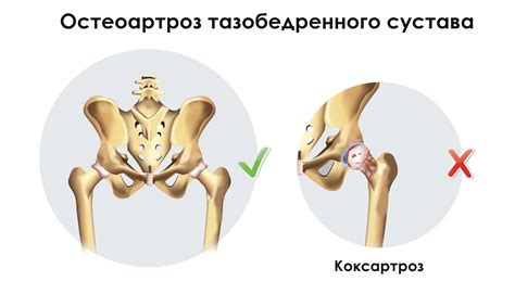 Что такое коксартроз тазобедренного сустава