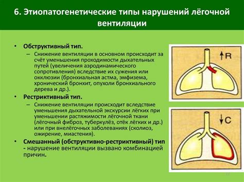 Что такое легкая рестрикция?