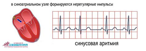 Что такое легкая синусовая аритмия?