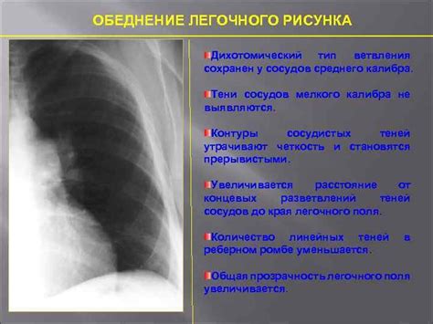 Что такое легочные поля повышенной прозрачности?