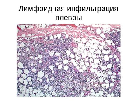 Что такое лимфоидная инфильтрация стромы опухоли?