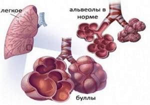 Что такое мелкие субплевральные апикальные буллы легких?