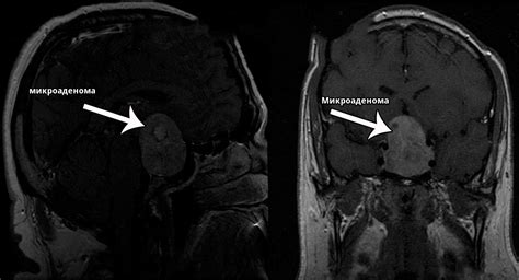Что такое микроаденома гипофиза?