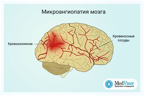 Что такое микроангиопатия головного мозга?