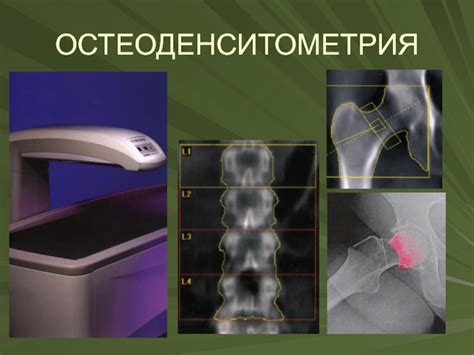 Что такое минеральная плотность костей?