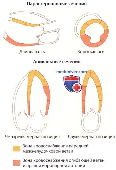 Что такое нарушение локальной сократимости левого желудочка?