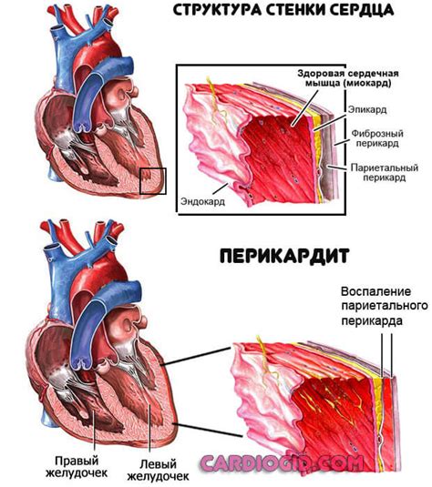 Что такое нарушение предсердной проводимости?