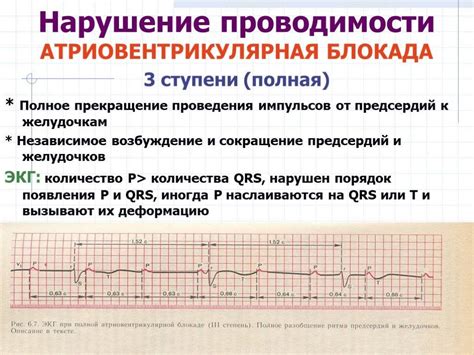 Что такое нарушение проводимости БПН?