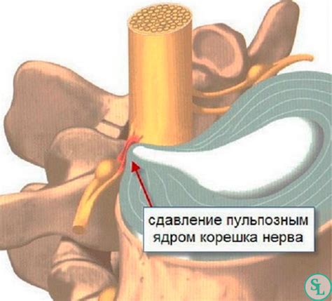 Что такое невральная компрессия?