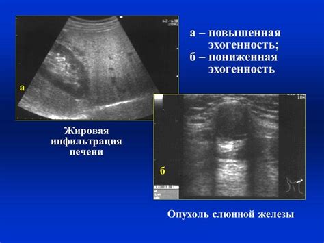 Что такое незначительно повышенная эхогенность?