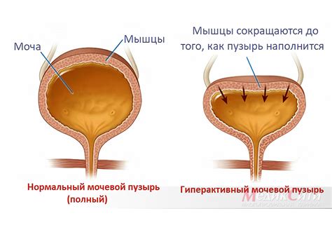 Что такое нейрогенный мочевой пузырь?