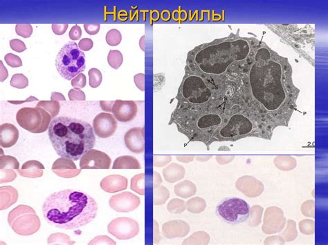 Что такое нейтрофилез со сдвигом влево и как он развивается