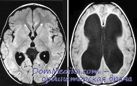 Что такое необтурационная гидроцефалия?