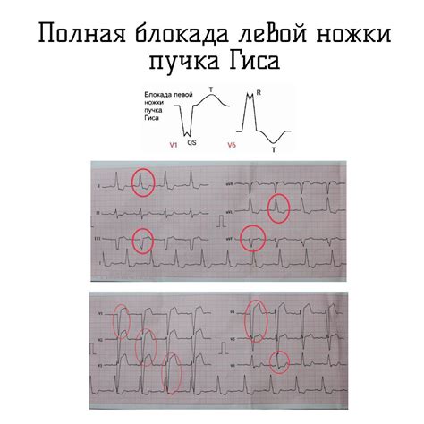 Что такое неполная блокада левого пучка Гиса?