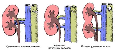 Что такое неполное удвоение левой почки?