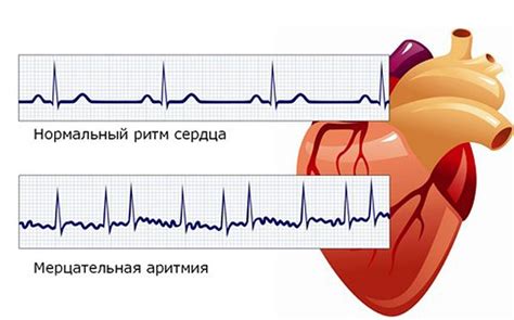 Что такое неравномерный сердечный ритм и как его лечить