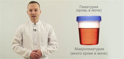 Что такое неспецифическая гематурия R31?