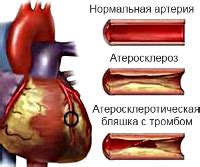 Что такое нестабильная стенокардия?