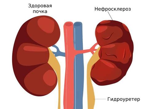 Что такое нефроптоз справа