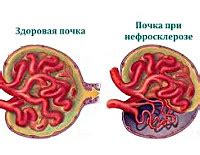 Что такое нефросклероз правой почки?