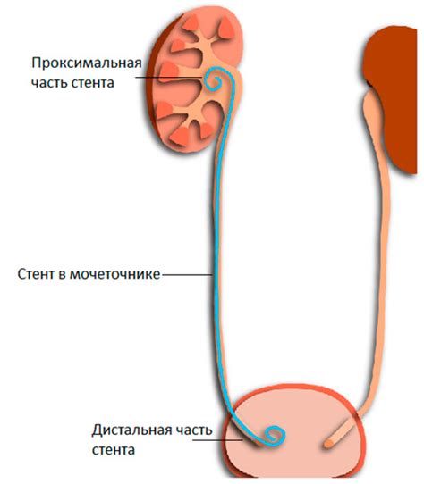 Что такое нефростомия