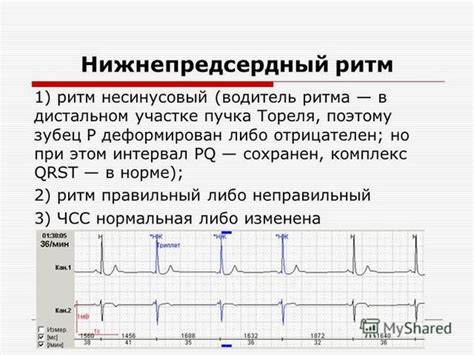 Что такое нижнепредсердный ритм на ЭКГ?