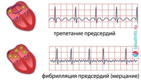 Что такое нормосистолия ритм умеренно нерегулярный?